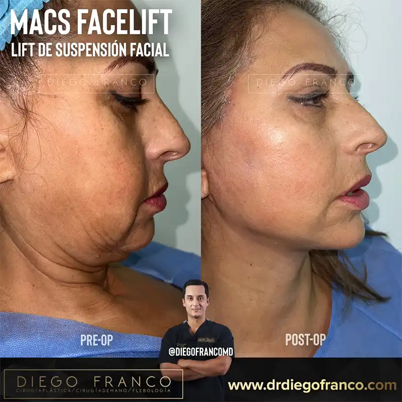 Img-Dr. Diego Franco-Antes&Despues-Lifting_Facial-1