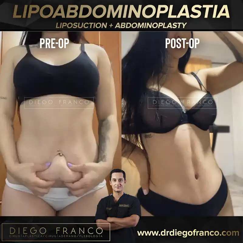 Img-Dr. Diego Franco-Antes&Despues-Lipoabdominoplastia-1