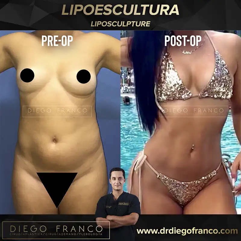 Img-Dr. Diego Franco-Antes&Despues-Lipoescultura-5