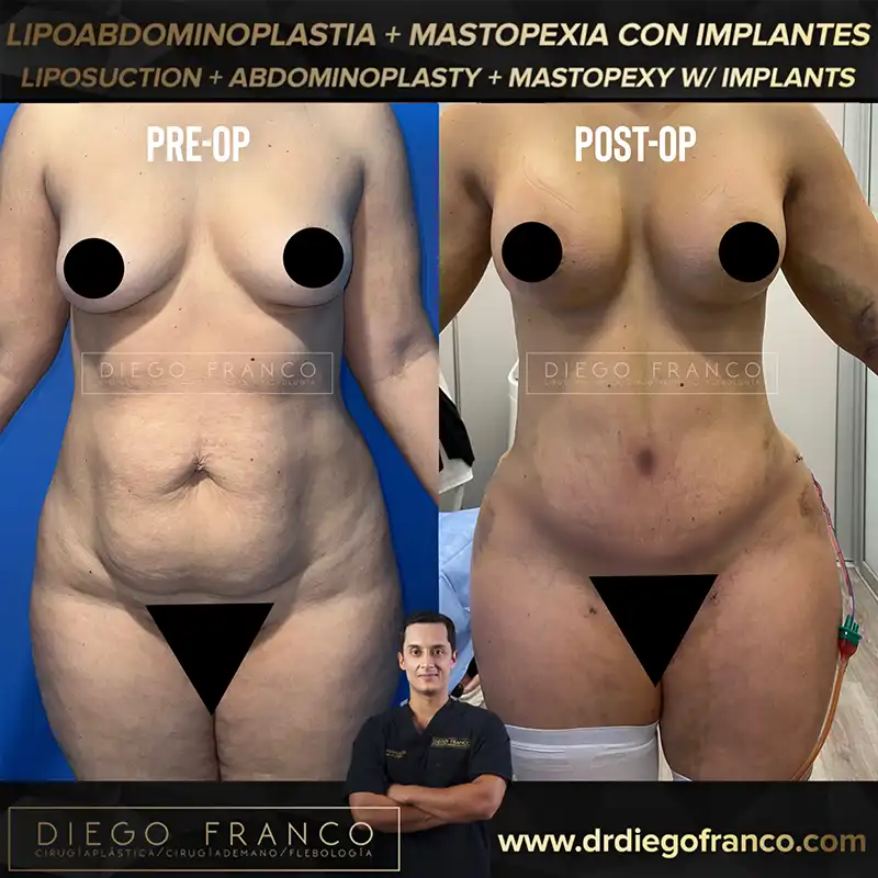 Img-Dr. Diego Franco-Antes&Despues-Mommy_Makeover-1